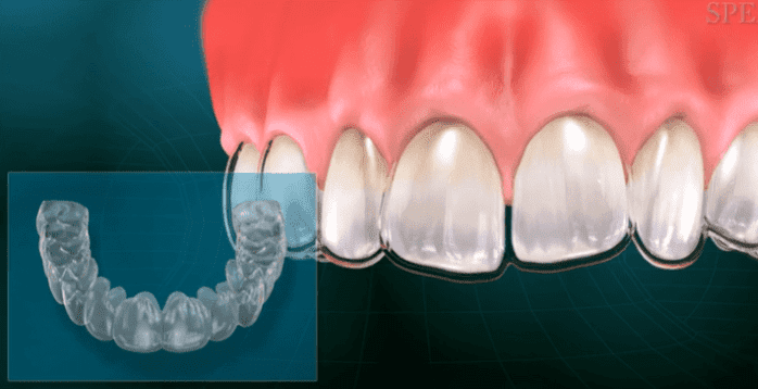 Invisalign